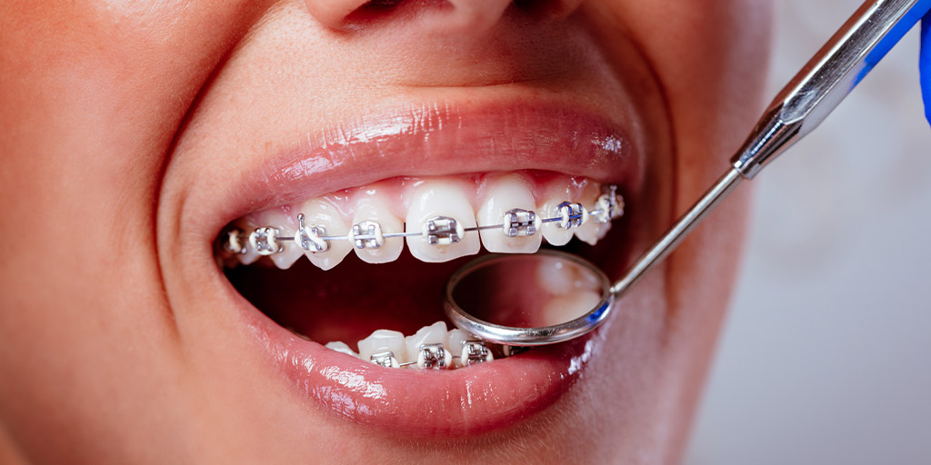 1024x512_0016_checking-braces-2023-11-27-05-01-21-utc